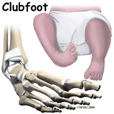 Image result for Clubfoot