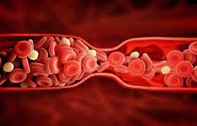 The Dangers Of Excessive Blood Clotting Vascular Health Clinics
