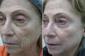 Basic chemical peeling: Superficial and medium-depth peels