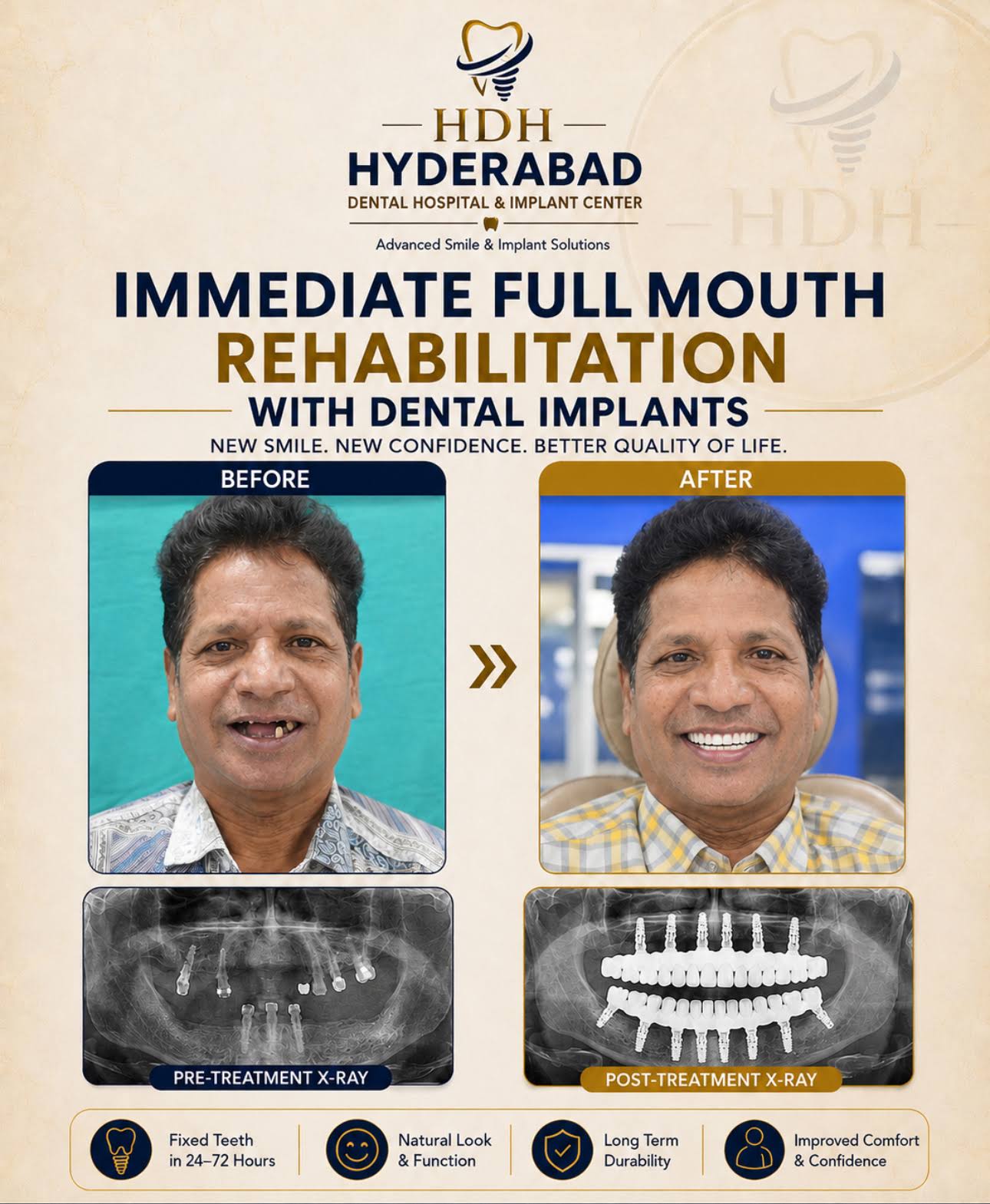 Full mouth Rehabilitation with Dental Implants