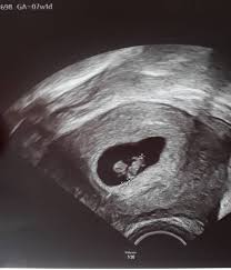 Ultraschall 8 Ssw Forum Fur Dezember 2020 Mamis