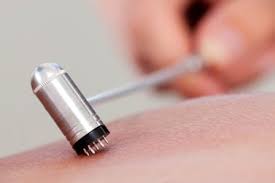 The following are the commonly used acupressure points to reduce hair loss that you can do on your own. Acupuncture And Herbs Regenerate Hair For Alopecia Areata Patients