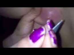 kadinin koltuk altindaki kil donmesinin temizlenmesi sivilce patlatma sivilce sikma youtube