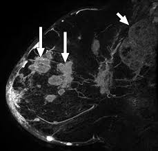 Image result for Inflammatory breast cancer