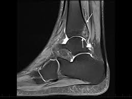 Fractures of the medial malleolus may occur as a result of playing sports. Posterior Malleolus Fracture Fifa Medical Platform