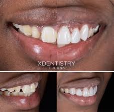 Plan b covers major restorative procedures such as crowns, onlays, veneers, bridgework and dentures. Tijuana Dentist Prices Best Dental Clinics Tijuana Dental Prices