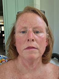 DIY bee sting remedies