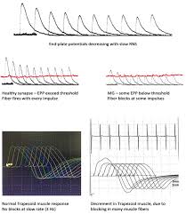 The muscles of the arms and legs may be involved, causing affected individuals. Jcm Free Full Text Diagnosis Of Myasthenia Gravis