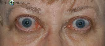 The studies of the pathogenesis of graves' disease which have been reviewed deal especially with the mechanisms that produce overactivity of the thyroid gland (hyperthyroidism) and exophthalmos. Thyroid Eye Disease