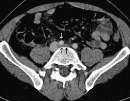 Computed Tomography Findings In 10 Cases Of Iliac Vein Compression May Thurner Syndrome European Journal Of Radiology
