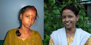Tuberculosis (tuberculosis patient) in most cases does not require inpatient treatment for an inactive form of the disease and is not limited in movement and social activity. Bantra St Thomas Home Welfare Society Ppm Project