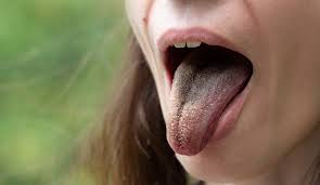 The typical cause of black hairy tongue is an overgrowth of yeast or bacteria. Black Hairy Tongue What It Is And What To Do About It Maiden Lane