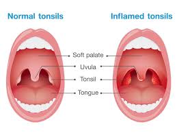 Avoid pollutants, such as cigarette smoke and car exhaust. Tonsils Facts Function Treatment Live Science