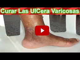 Pin On Ulceras Varicosas