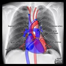 In this article we will focus on: Radiopaedia Org Chest X Ray Anatomy By Dr Vincent Tatco Facebook
