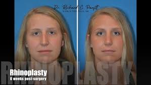 Choosing facial cosmetic surgeon Dr. Richard Parfitt for Rhinoplasty