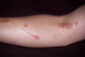 Learn how rashes like hives, shingles, herpes, and others are diagnosed. Rash From Poisonous Plants Picture Image On Medicinenet Com