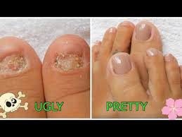 Polygel Toenails W Dual Forms On Toes With No Nails Beginner Detailed Step By Step Youtube Acrylic Toe Nails Toe Nails Acrylic Toes Easy diy acrylic toenails😍~trendy toenails~ quarantine toenails😍.