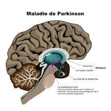 En avril 2018, le dr stéphane hunot a répondu aux questions des internautes sur cette maladie. Maladie De Parkinson Symptomes Esperance De Vie Traitements
