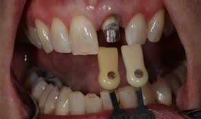 We recommend itsuse with a resin cement like anchor. How To Use Gc Fuji Plus For Seating An Anterior Full Coverage Zirconia Crown Restoration