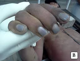 Image result for Copper Poisoning