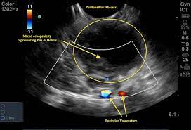 Thyroid nodules are lumps that can appear in the thyroid gland in front of the throat. Sore Throat Emory School Of Medicine