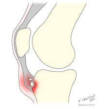 Osgood Schlatter Disease Radiology Reference Article Radiopaedia Org
