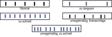 Lukaskrankenhaus Neuss Medizinische Klinik I Herzrhythmusstorungen