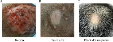 Image result for Tinea Capitis
