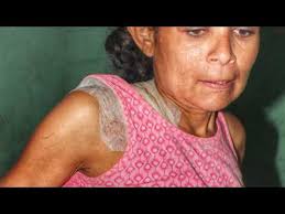 PADECE DE INSUFICIENCIA RENAL ~ Soy De Chiquimulilla