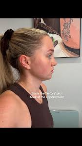 Tratamiento Hifu Facial Antes Y Fespues