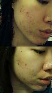 I Tried Tea Tree Oil For Acne And It Actually Worked