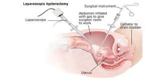 Check spelling or type a new query. Laparoscopic Hysterectomy Surgery Center And Women Health