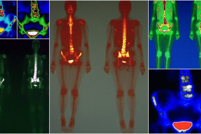 Radiopharmaceutical nuclear medicine imaging