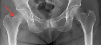 Dolor En La Ingle Despues De Sujetar La Cadera The Leone Center For Orthopedic Care