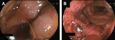 Image result for Small Intestinal Bleeding