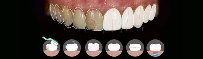 Aesthetic dentistry · shade matching · mock preparation and wax up · selection of burs · step by step preparation · gingival retraction · final impression · various . How Long Does Cosmetic Dentistry Last Revitalise Dental Centre