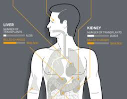2017 U S Organ And Tissue Transplant Cost Estimates And Discussion