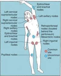 Pin On Hodgkins Lymphoma