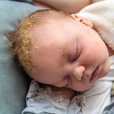 Image result for Cradle Cap
