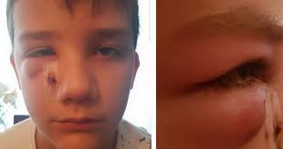 Staffordshire schoolboy, 11, tries to kill himself after cruel bullies  brutally beat him with metal pole