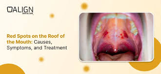 Image result for Canker sores symptoms roof of the mouth