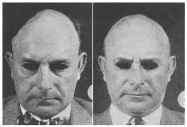 USE OF TANTALUM FOR FACIAL AND CRANIAL DEFECTS