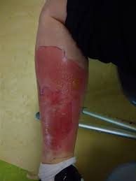 Some people may notice minor stinging such as that felt with a bee sting when bitten by the spider. Noble False Widow Bites Can Require Hospital Treatment Study Finds