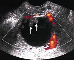 If you are postmenopausal, there is a slightly higher risk of ovarian cancer. Ovarian Cancer Oncology Medbullets Step 2 3