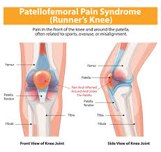 Image result for Patella Mobility Test