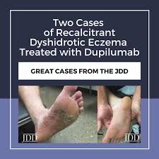 Image result for pompholyx soles of feet