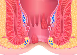 Image result for itchy skin rectum