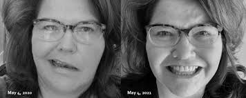 My Bell's Palsy Journey: From Pity Party to Really...Slow...Recovery