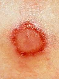 Spider Bites That Look Like Mosquito Bites Pin On Fitness